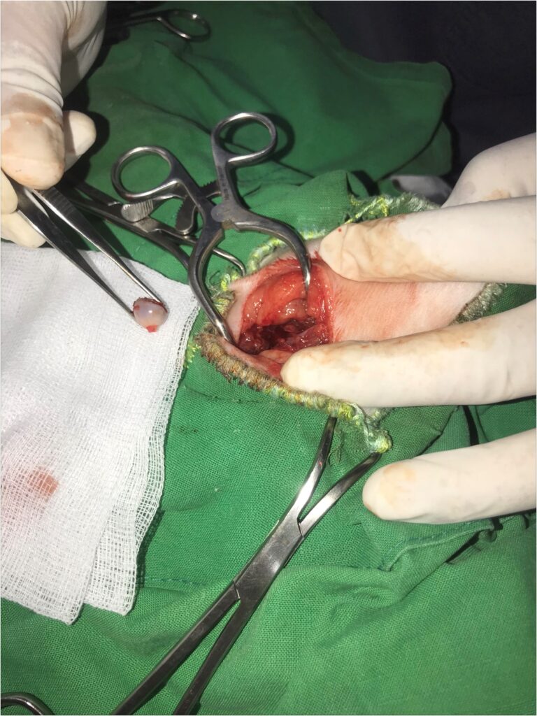 Dr. Hu phẫu thuật cắt bỏ lồi cầu xương đùi