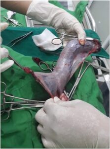 Dr. Hu phẫu thuật và xử lý thai chết lưu