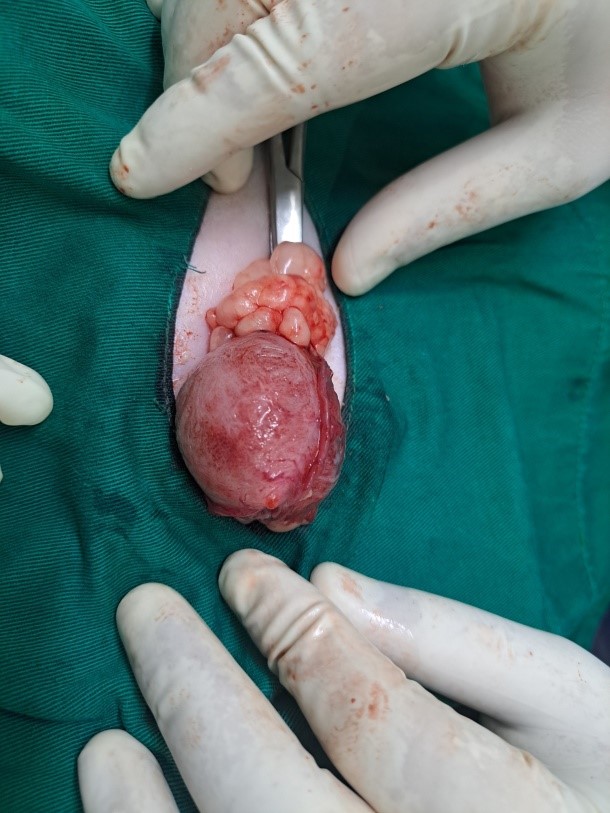 Phẫu thuật mổ bàng quang tại Samyang