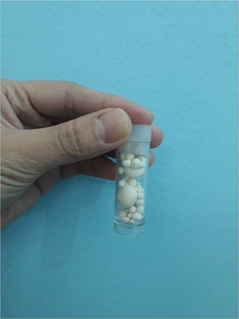 Toàn bộ sỏi đã được lấy ra
